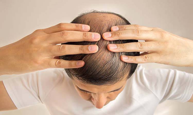 Obesity Leads To Hair Loss And Thinning, Study
