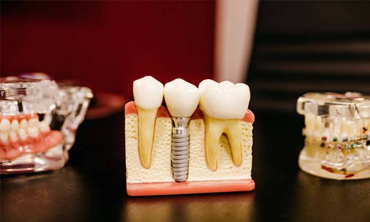 New drug can regenerate lost teeth!