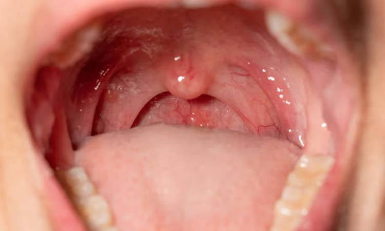 human papillomavirus on throat