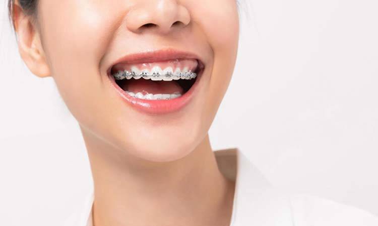Teeth Braces: All You Need To Know