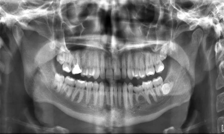 Dental X-Rays: All You Need To Know 