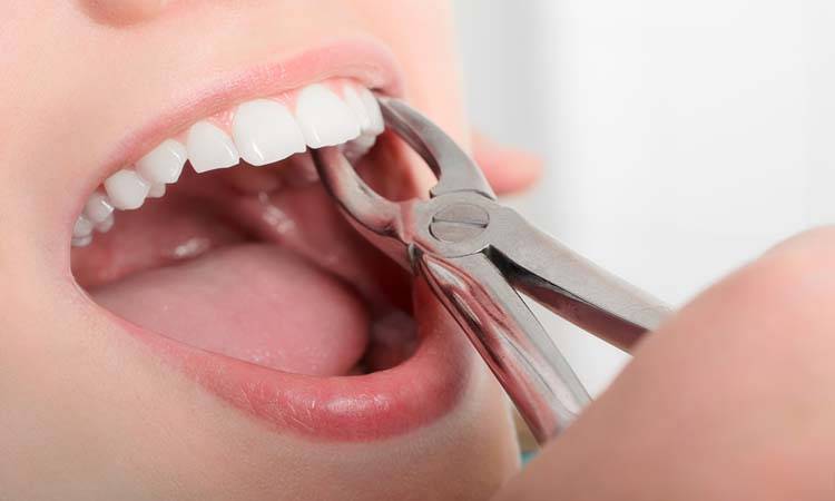 Woman finds no dentist, pulls teeth herself