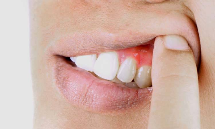 Bleeding gums: An early sign of disease
