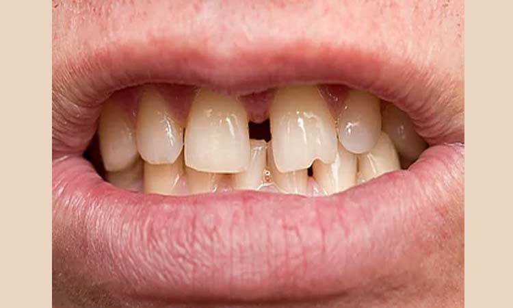 Extra Teeth: Have you heard about Mesiodens?