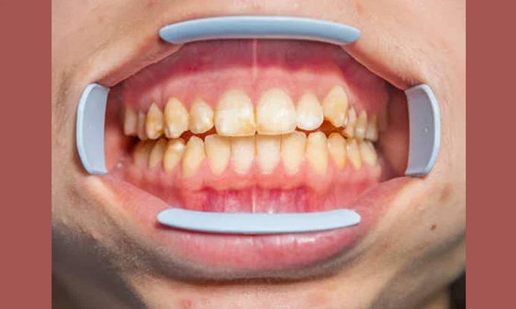 New study reveals cause of 'chalky teeth'