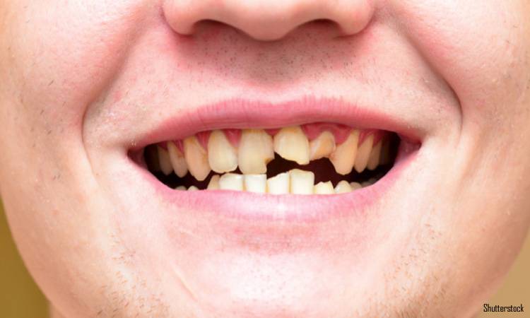 Ways to Prevent Chipped and Broken Teeth