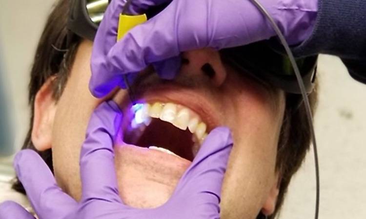 New dental tool can help prevent cavities