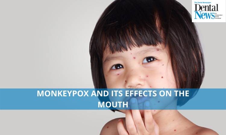 Monkeypox and Its Effects on the Mouth