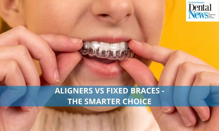Aligners vs Fixed Braces - The Smarter Choice