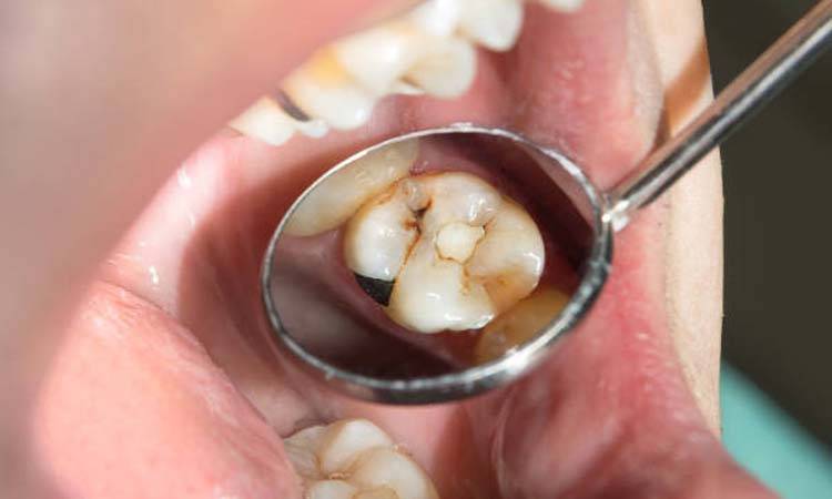 Tooth Decay and Diabetes: New Study Reveals the Real Cause