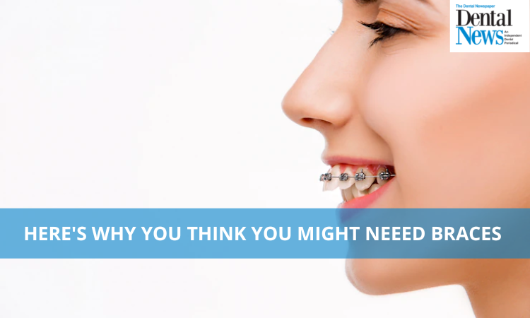 Here’s Why You Think You Might Need Braces