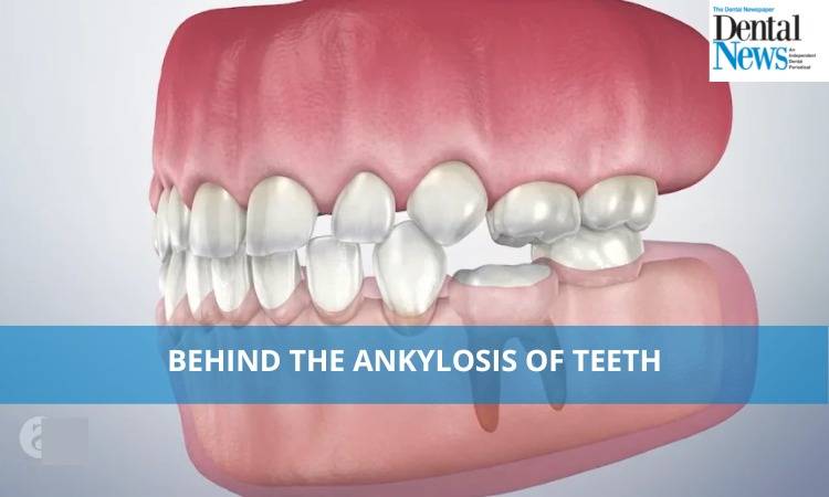 Behind the Ankylosis of Teeth 