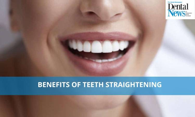 Benefits of teeth straightening