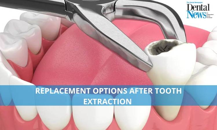 Options for Tooth Replacement Following Extraction
