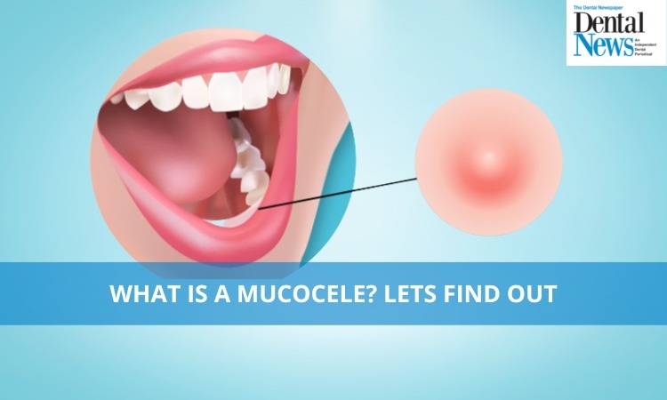 What is a Mucocele? Let's find Out