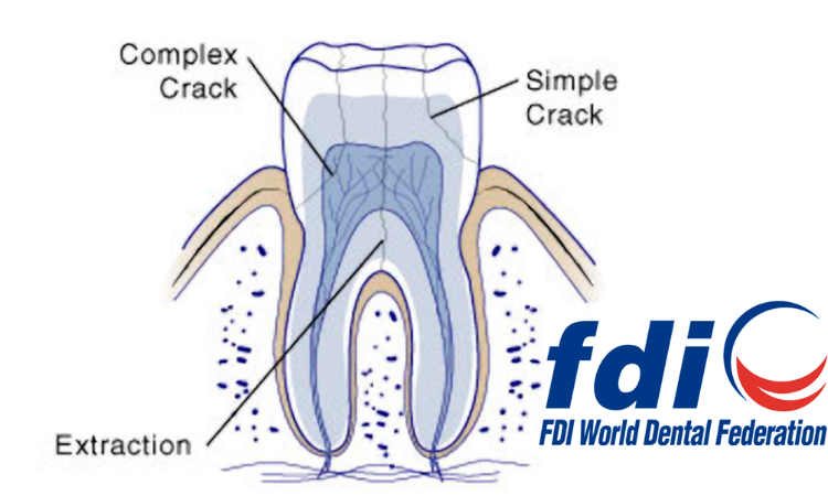 New recommendations from FDI on the cracked tooth syndrome