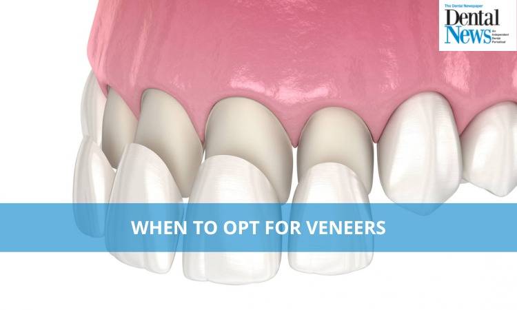 When To Opt For Veneers?
