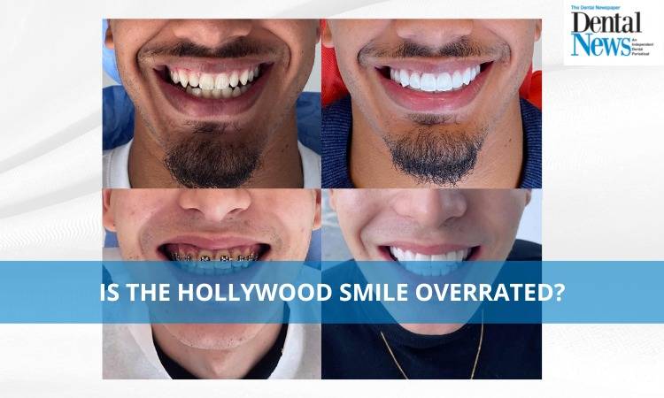 Is the Hollywood Smile overrated?