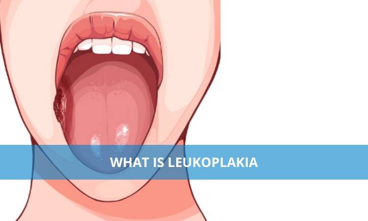 Leukoplakia: Causes, Symptoms, and Treatment