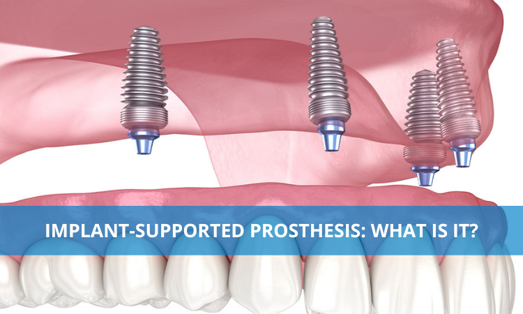 Implant-supported prosthesis: What is it?