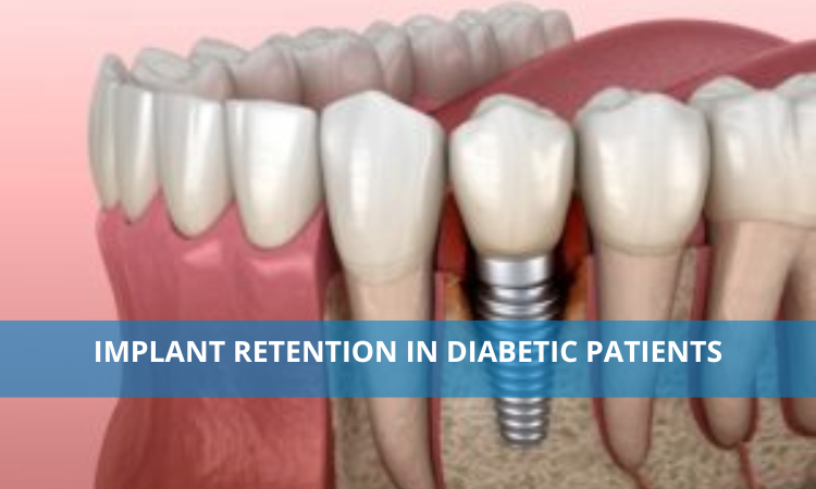 Implant Retention In Diabetic Patients