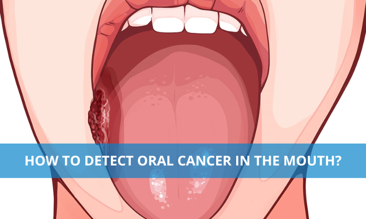 How to Detect Oral Cancer in the Mouth?
