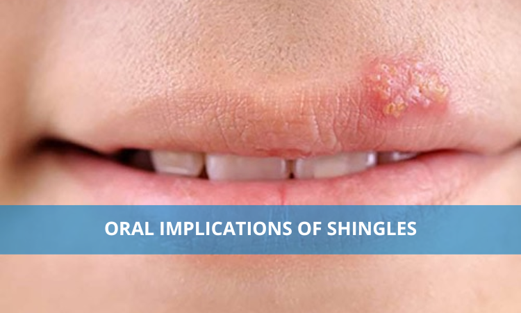 Oral implications of Shingles