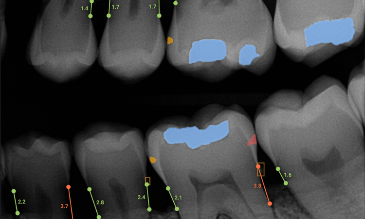 Overjet expands dental AI detection capabilities with FDA clearance