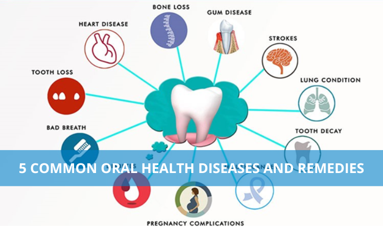 5 common oral health diseases and remedies
