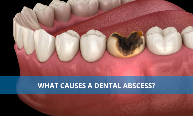 What causes a dental abscess?
