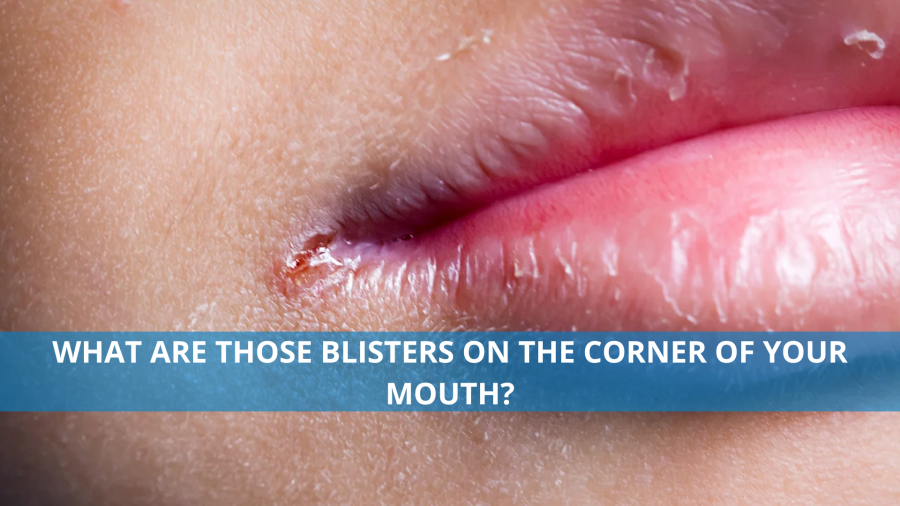 What are those blisters on the corner of your mouth?