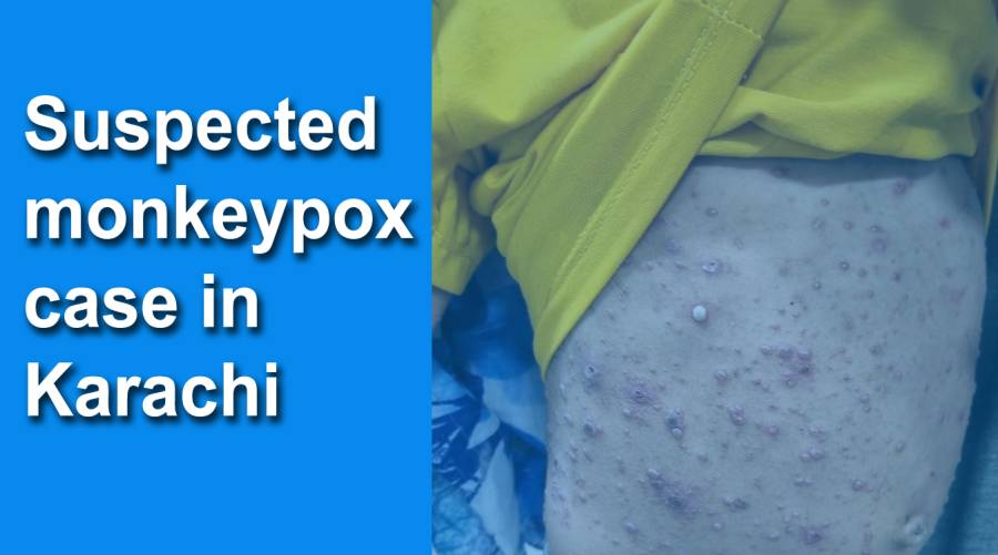 Suspected monkeypox case in Karachi