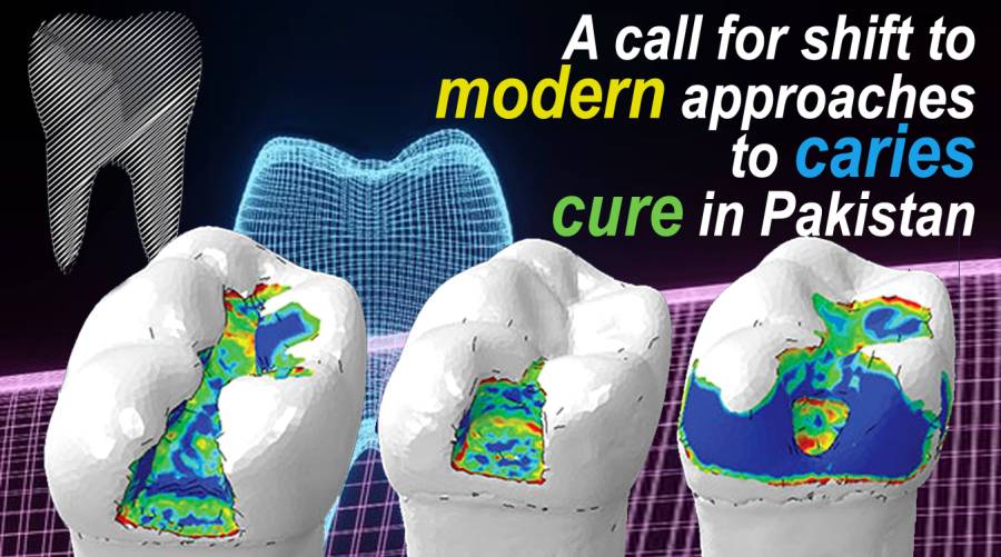 A call for shift to modern approaches to caries cure in Pakistan
